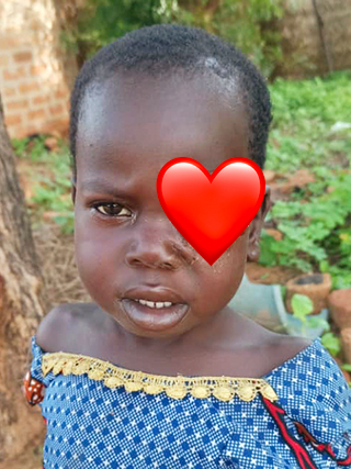 Augenkrebs Kind Kamerun