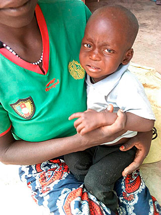 Hodenbruch Kind Kamerun